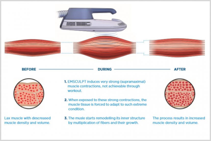 Emsculpt®: HIFEM® Technology