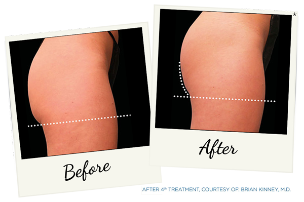 Butt Lifting Treatment by Emsculpt® Providers - Burn Fat & Build