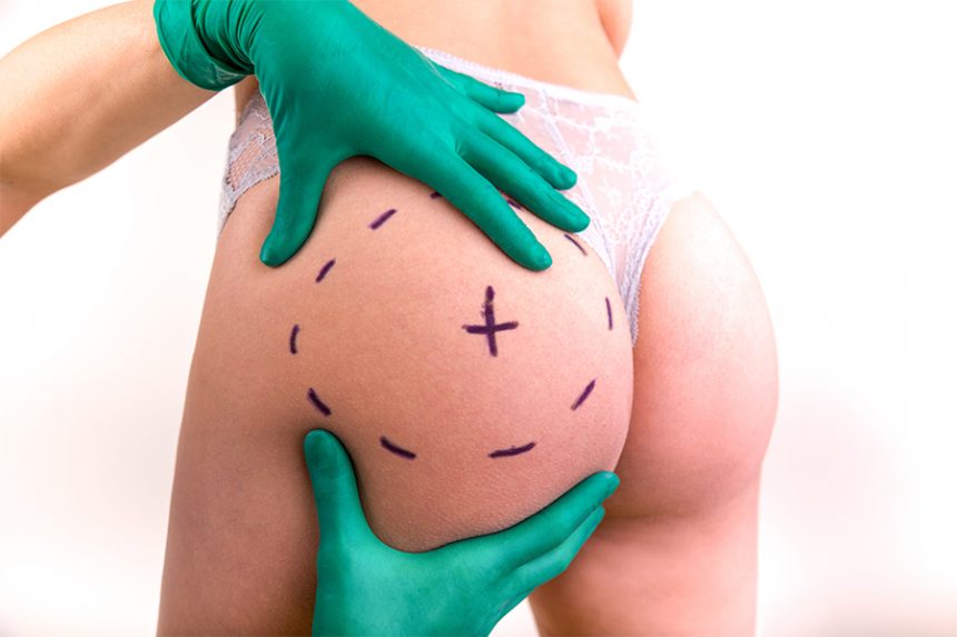 Emsculpt®: The Alternative Butt Lift