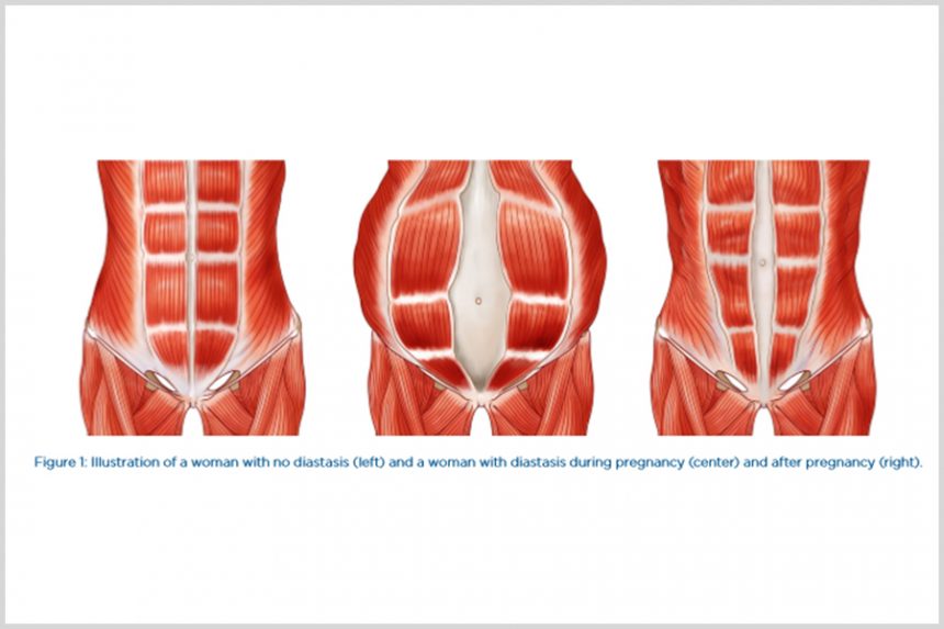 Diastasis Recti in Women